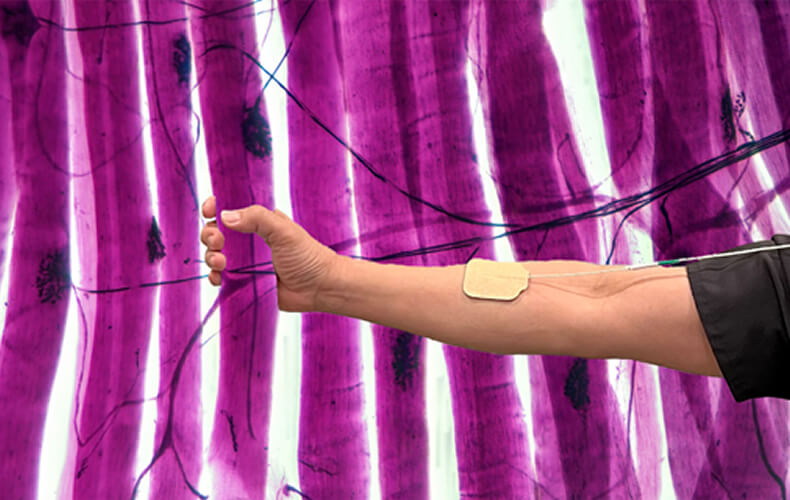 Arthrogenic Muscle Response